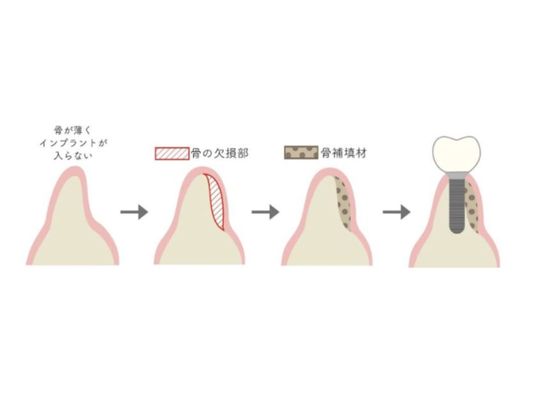 骨誘導再生法（GBR法）