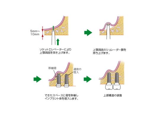 ソケットリフト法（上顎洞挙上術）