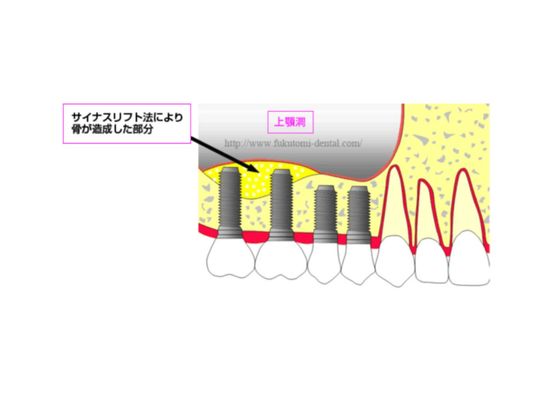 サイナスリフト法（上顎洞挙上術）